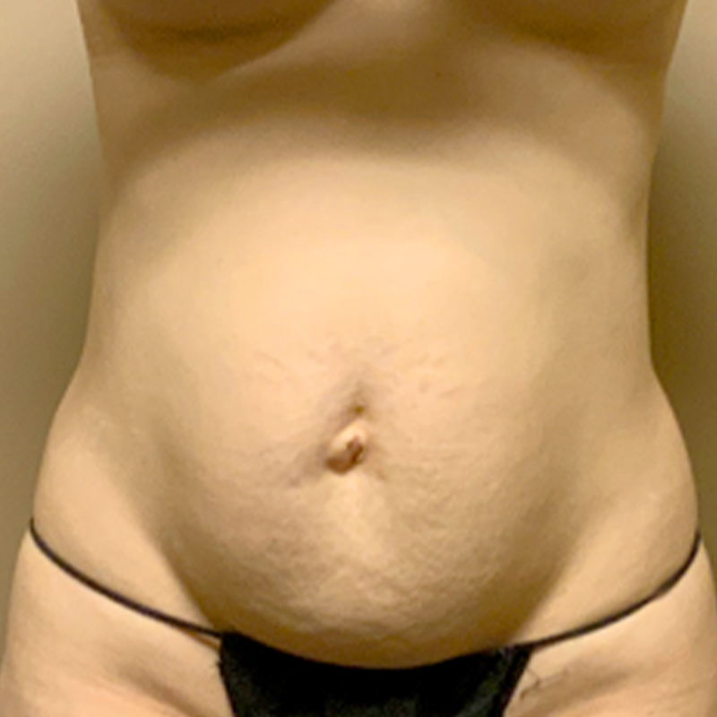 Liposuction Waist 01