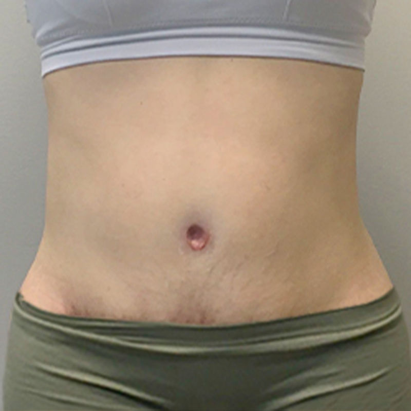 Liposuction Waist 10