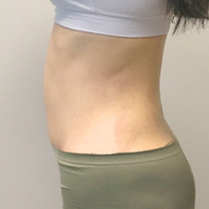 Liposuction Waist 05