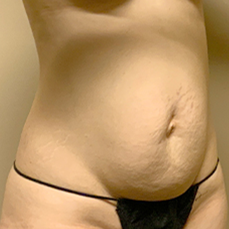 Liposuction Waist 07