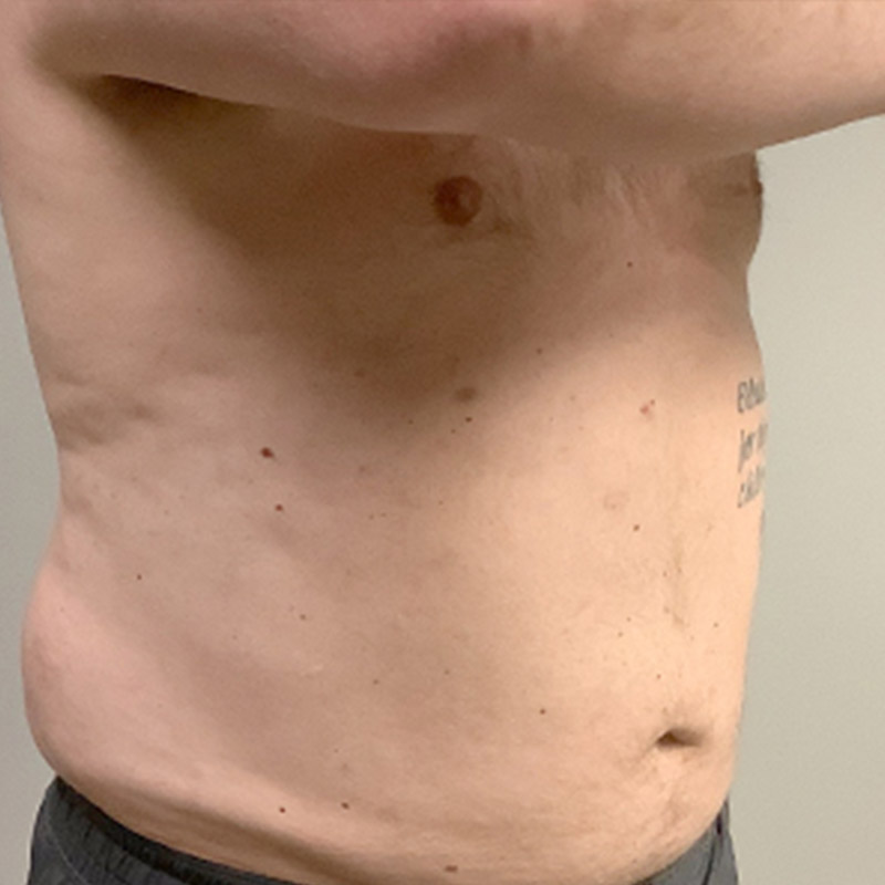 Liposuction Waist 09