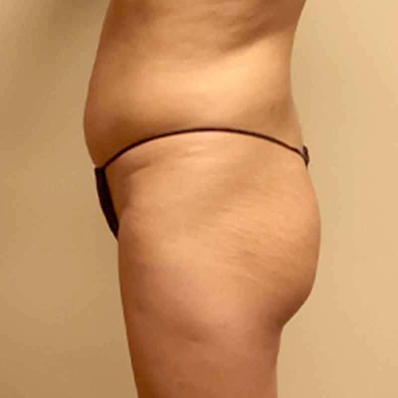 Liposuction Waist 05