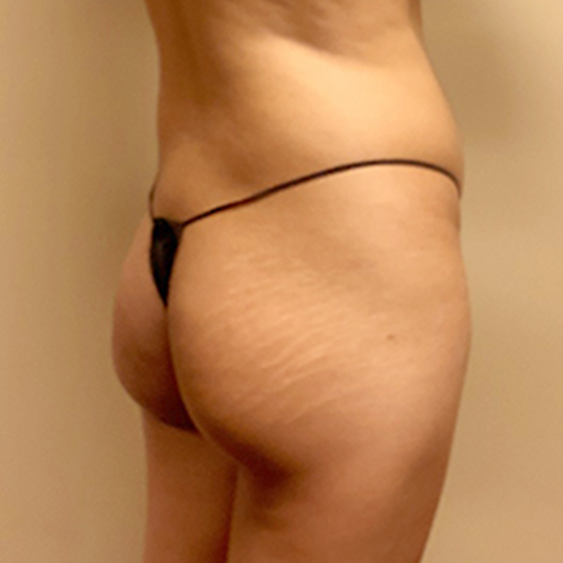 Liposuction Waist 09