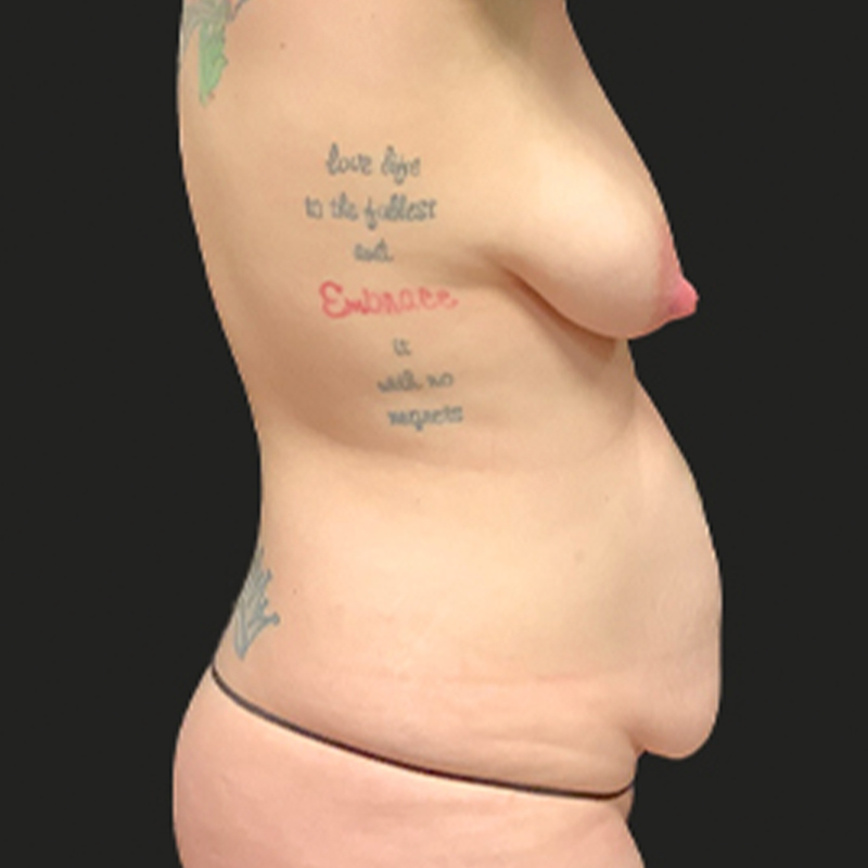 Liposuction Waist 09