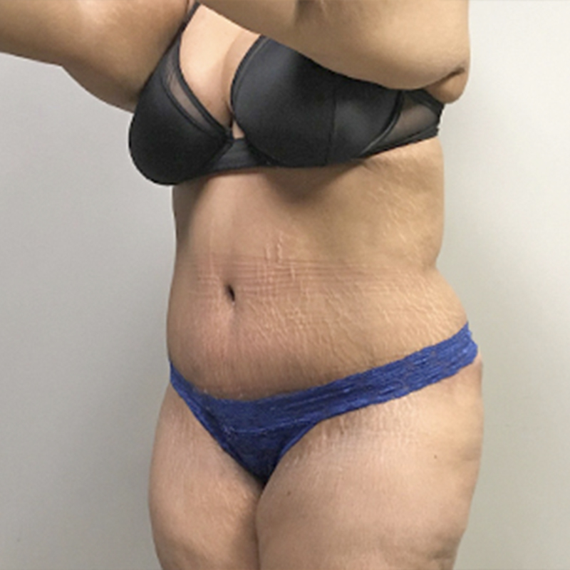 Liposuction Waist 03