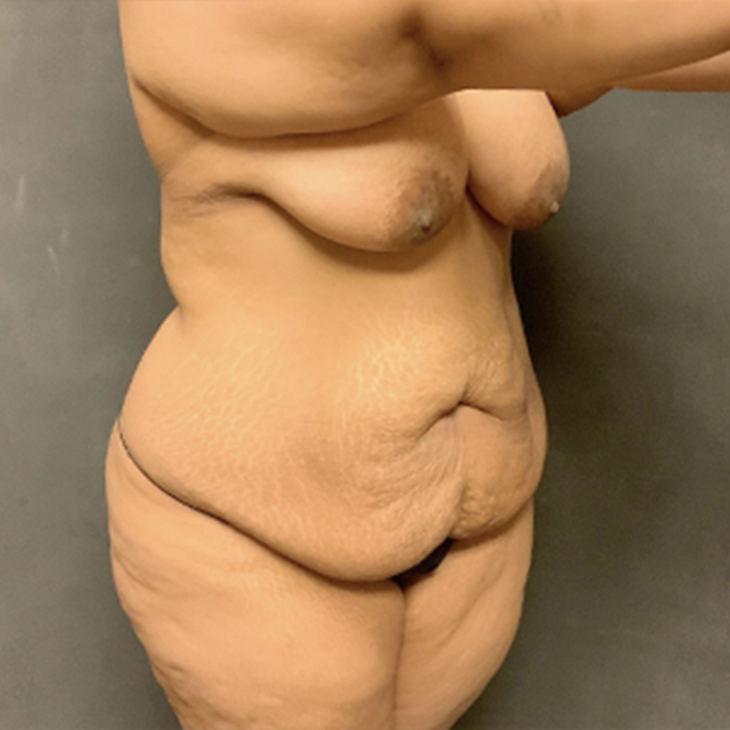 Liposuction Waist 07