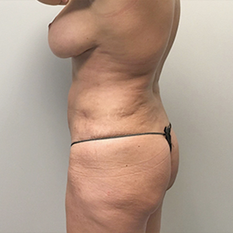 Liposuction Waist 03
