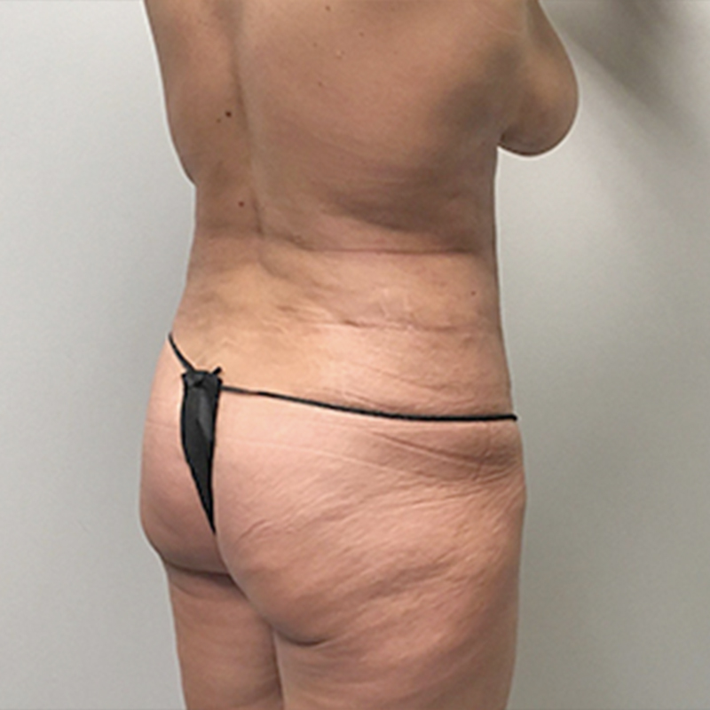 Liposuction Waist 05