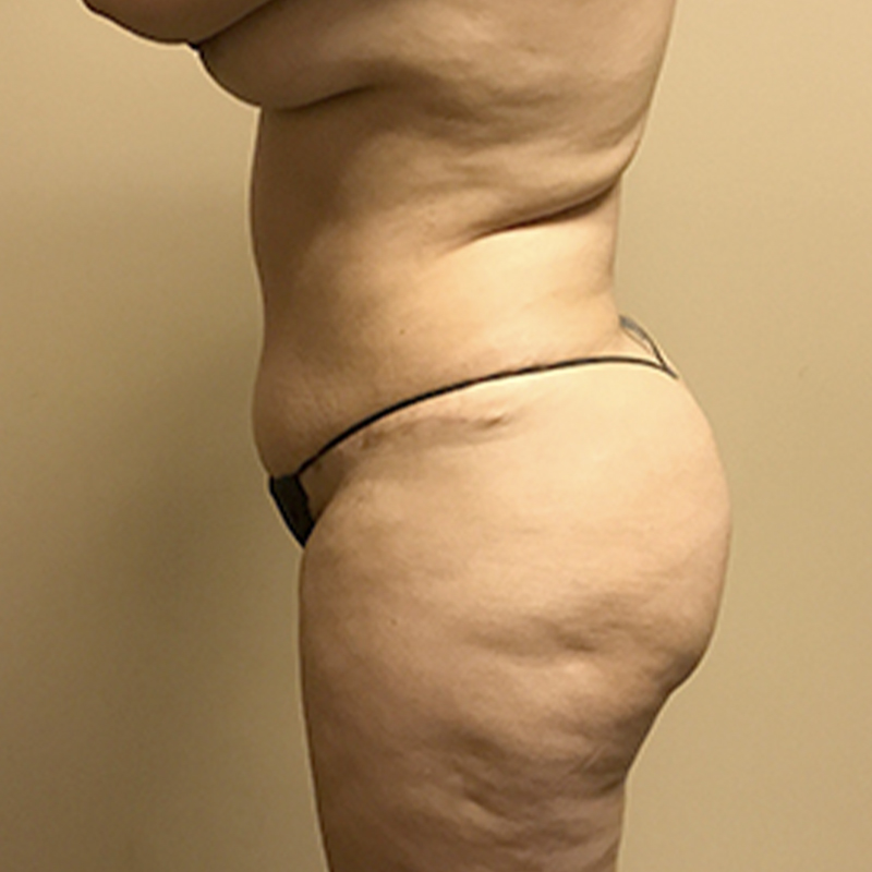 Liposuction Waist 09