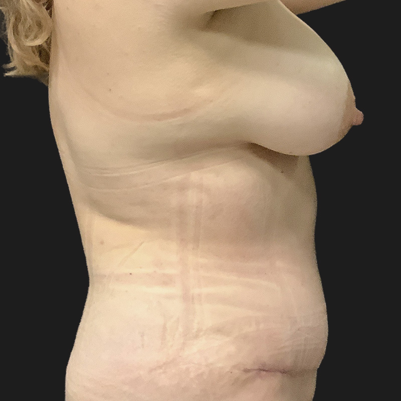 Liposuction Waist 05