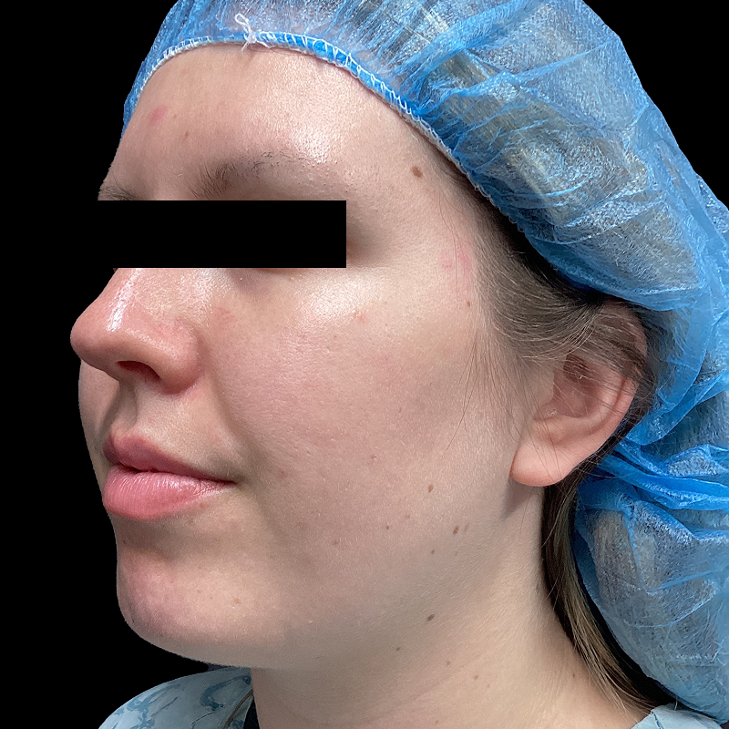 Lower Face Contouring 05