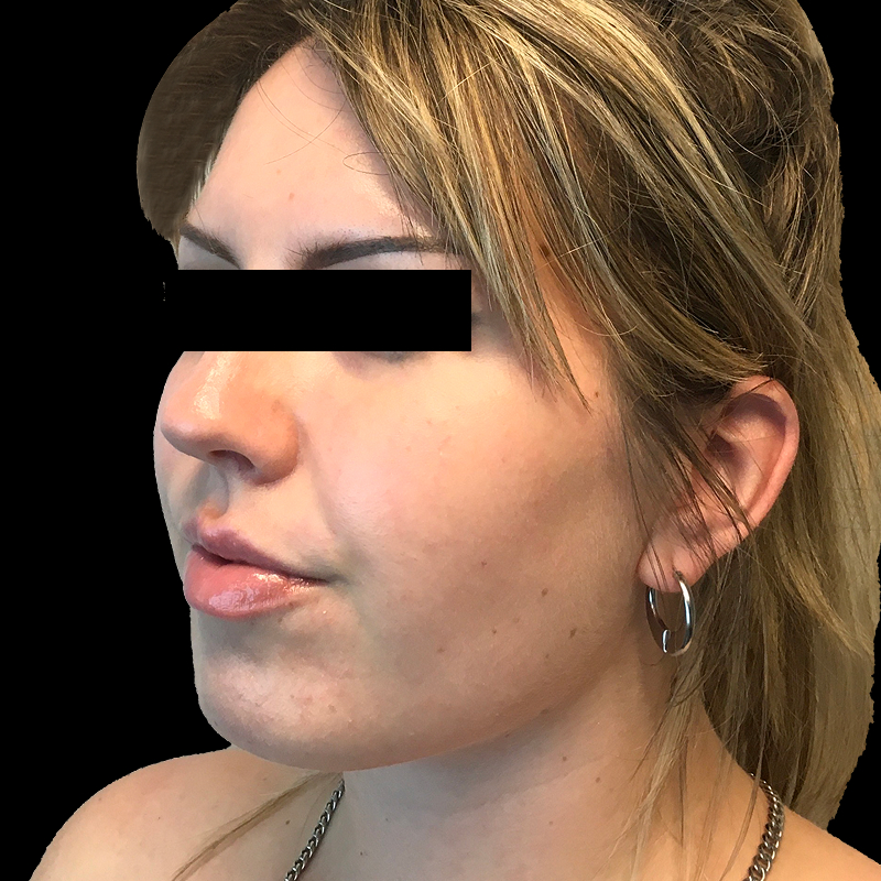 Lower Face Contouring 05