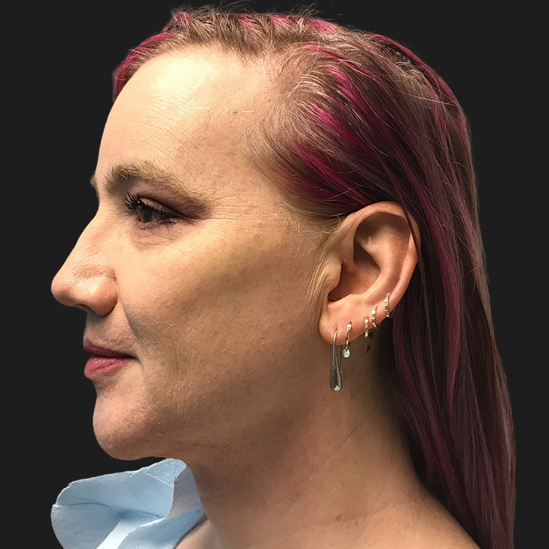 Lower Face Contouring 02