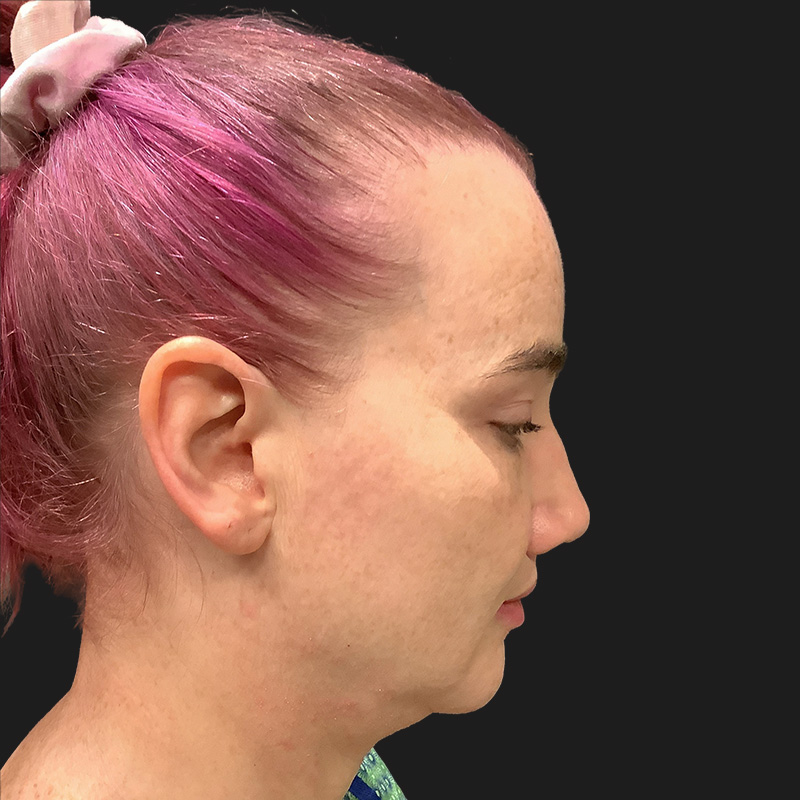 Lower Face Contouring 03