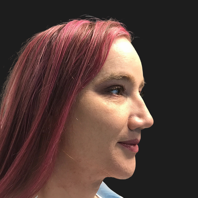 Lower Face Contouring 03