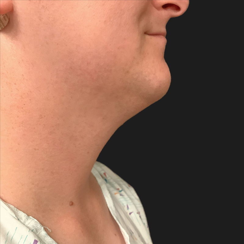 Lower Face Contouring 01