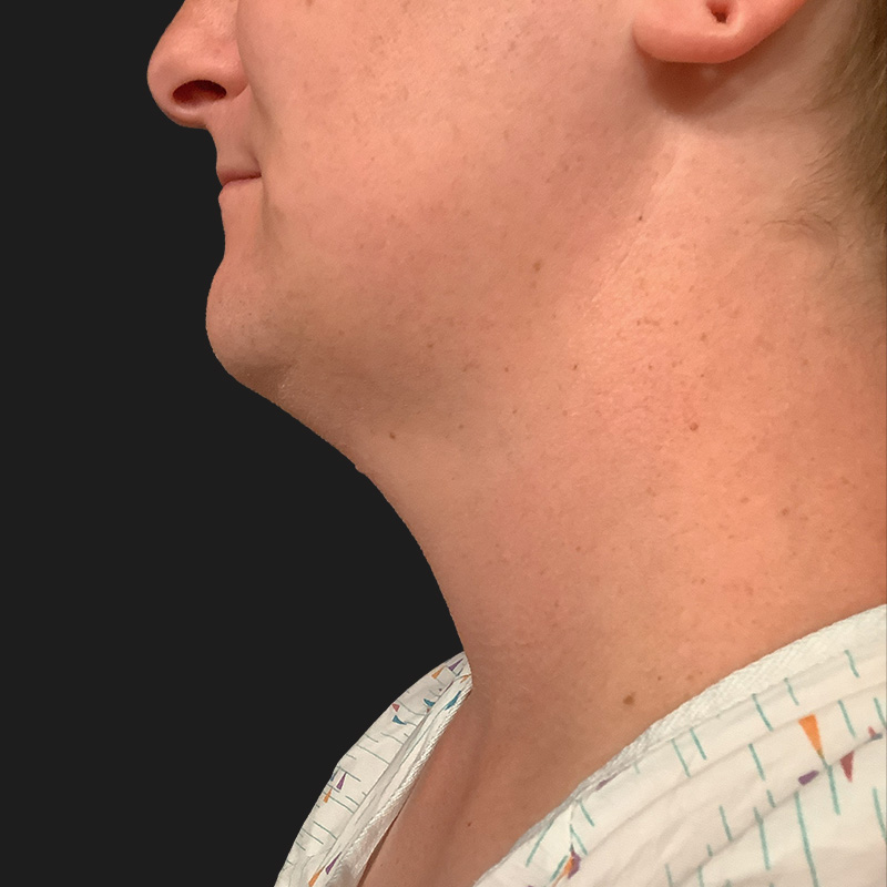 Lower Face Contouring 03