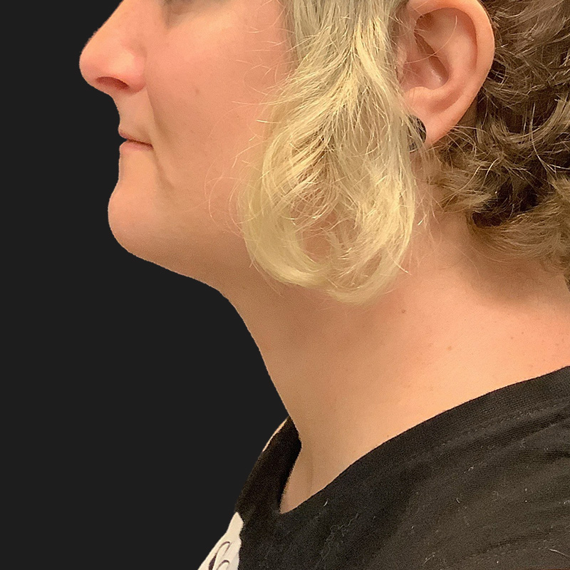 Lower Face Contouring 03