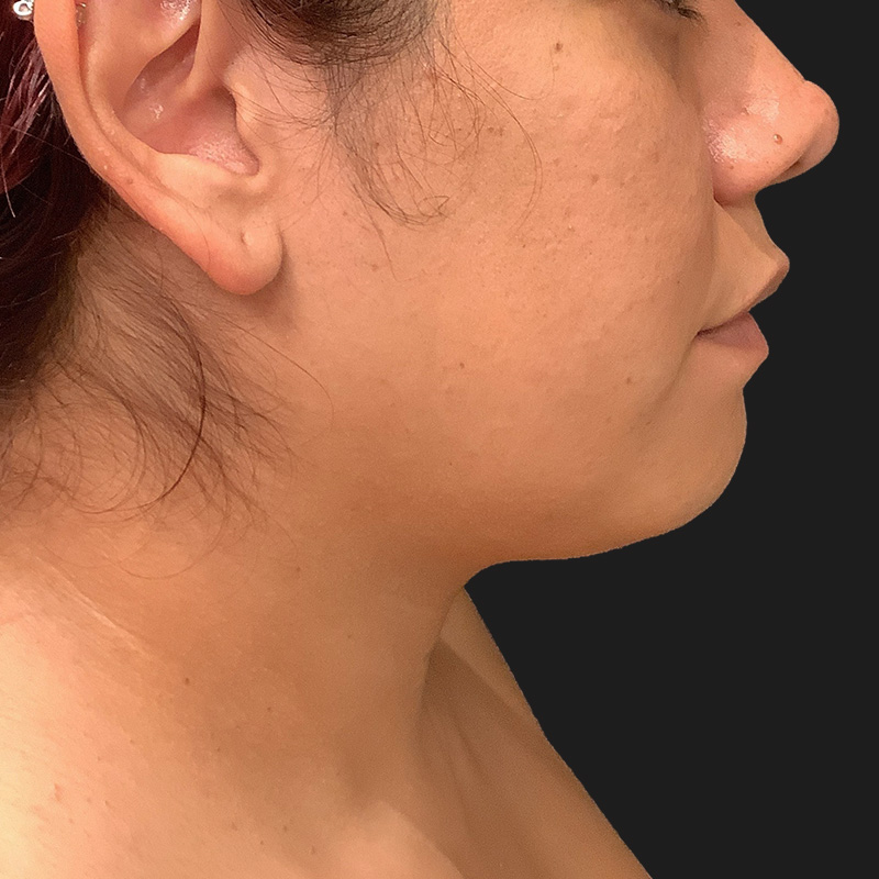 Lower Face Contouring 03