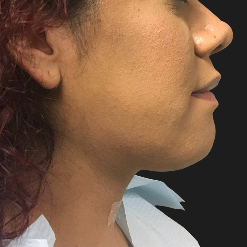 Lower Face Contouring 03