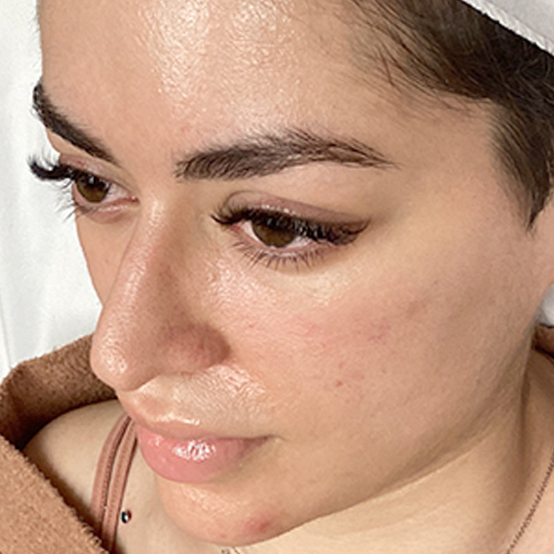 Microneedling 07