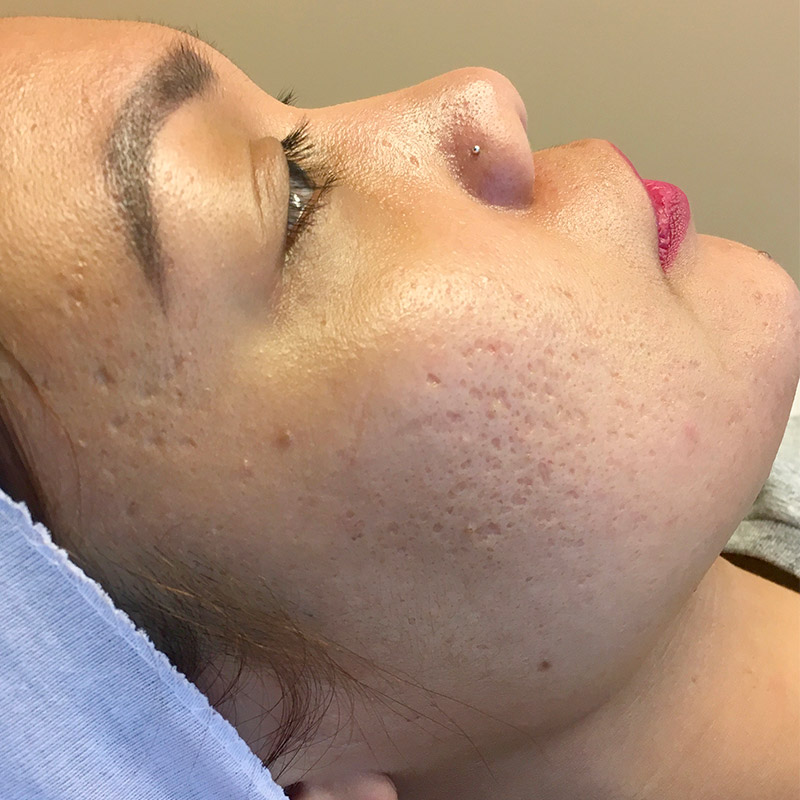 Microneedling 01