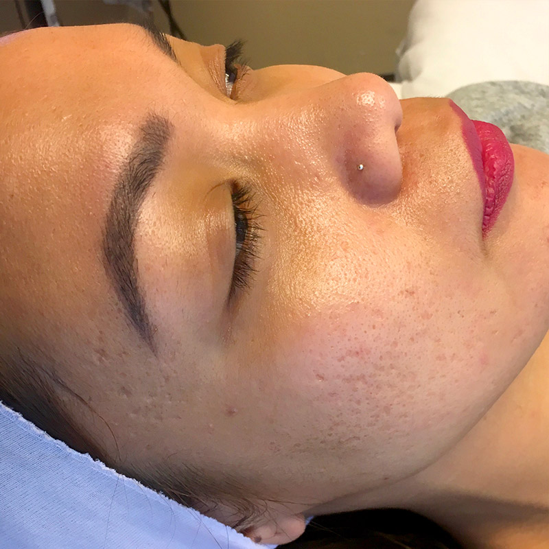 Microneedling 03