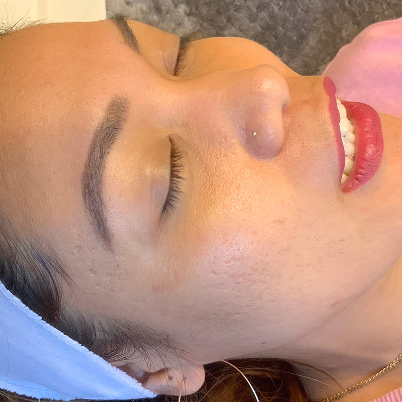 Microneedling 03