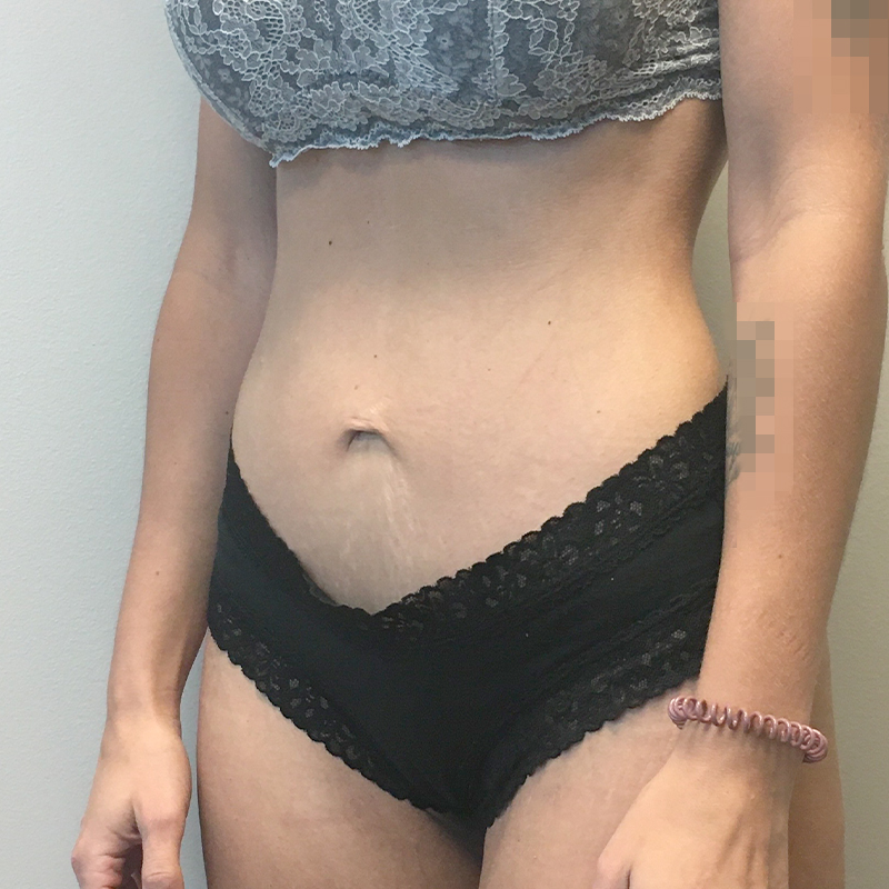 Mini Abdominoplasty 03