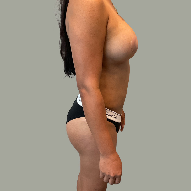 Mtf Body Contouring 05