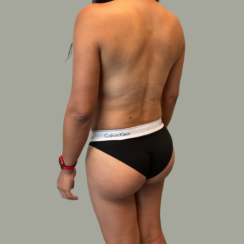 Mtf Body Contouring 09