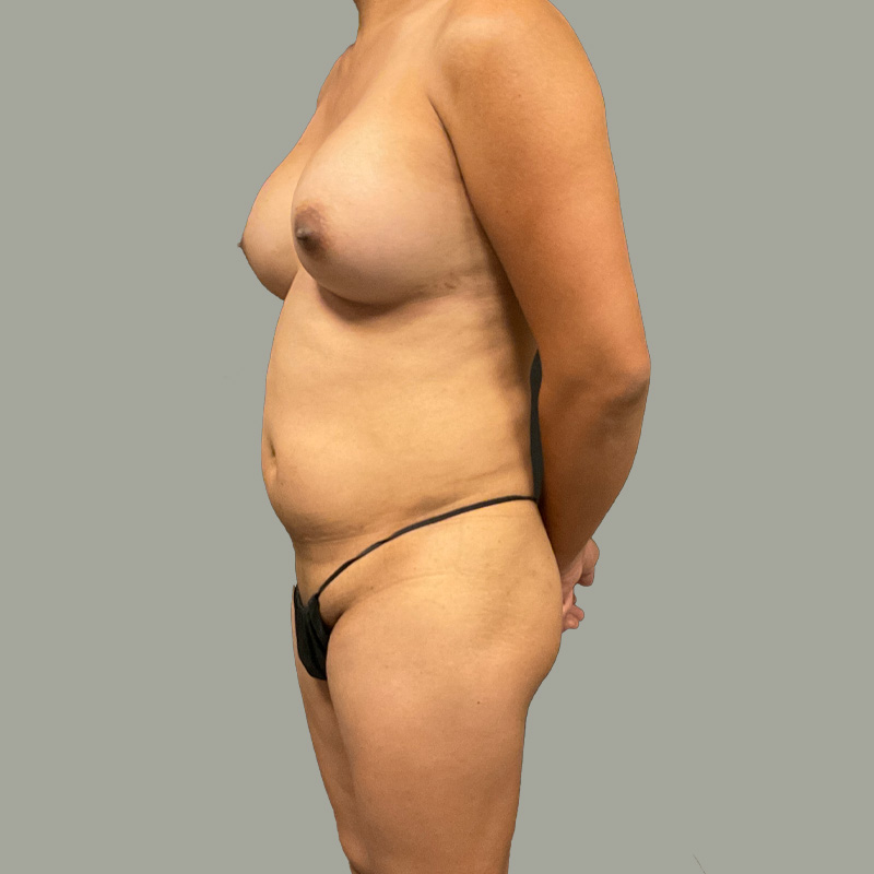 Mtf Body Contouring 11