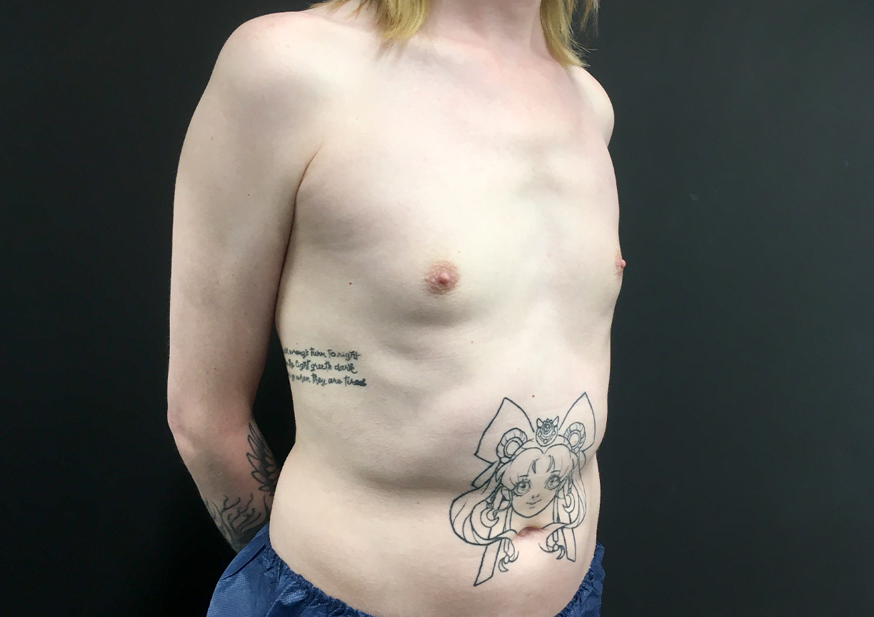 Mtf Breast Augmentation 07