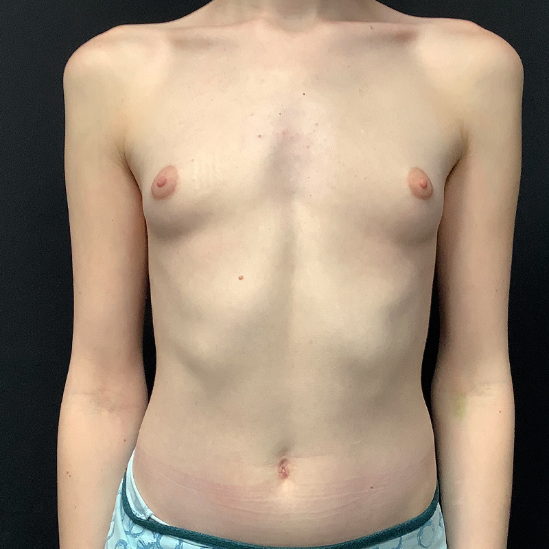 Mtf Breast Augmentation 01