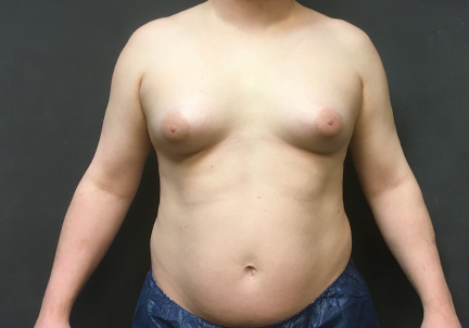 Mtf Breast Augmentation 03