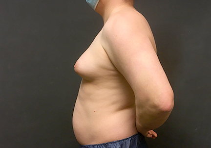 Mtf Breast Augmentation 07