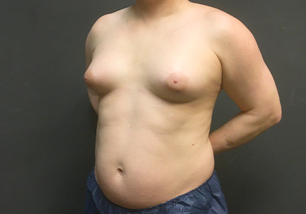 Mtf Breast Augmentation 09