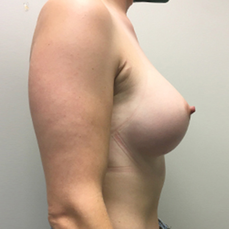 Mtf Breast Augmentation 05