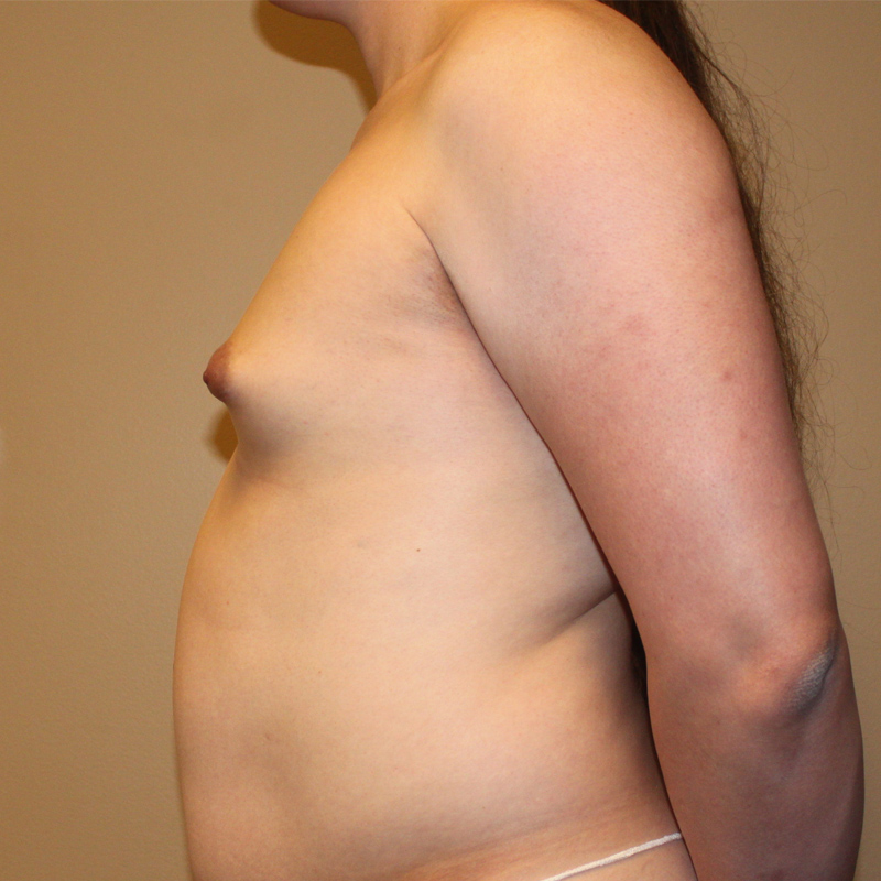 Mtf Breast Augmentation 09