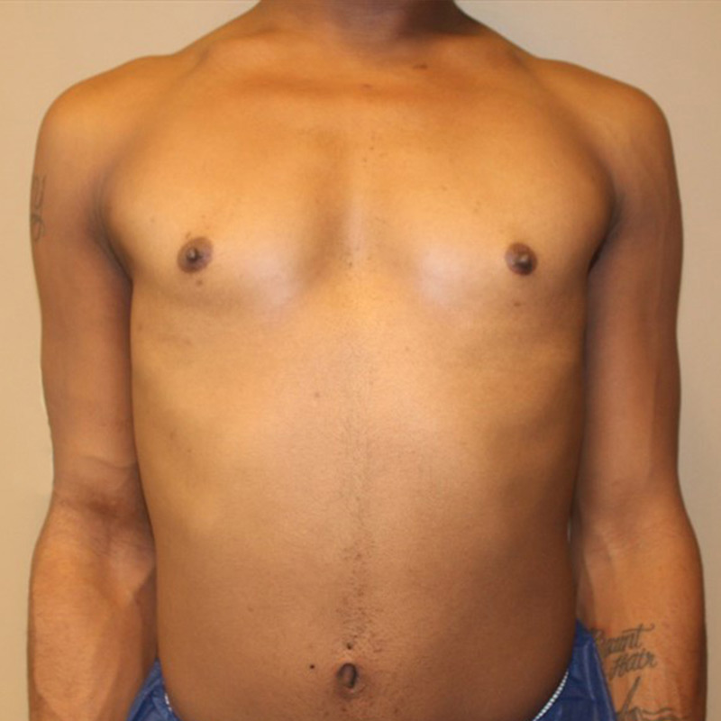 Mtf Breast Augmentation 01