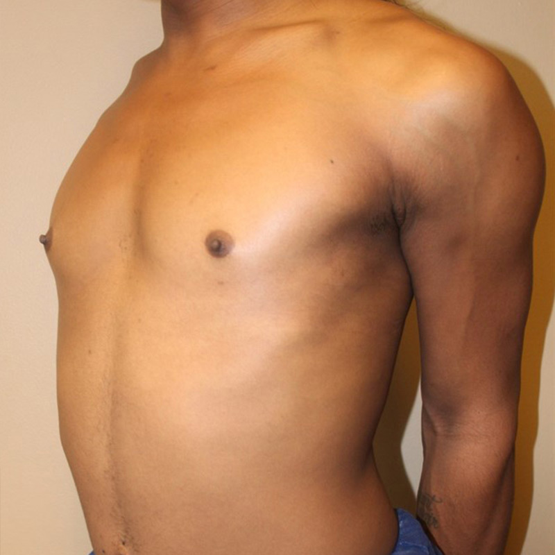 Mtf Breast Augmentation 07