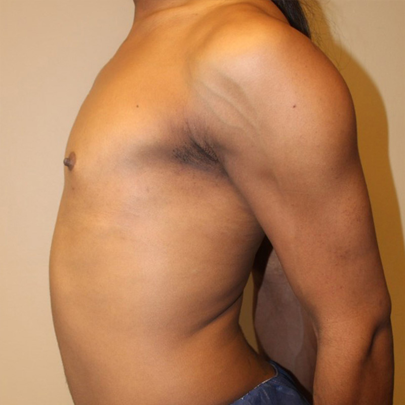 Mtf Breast Augmentation 09