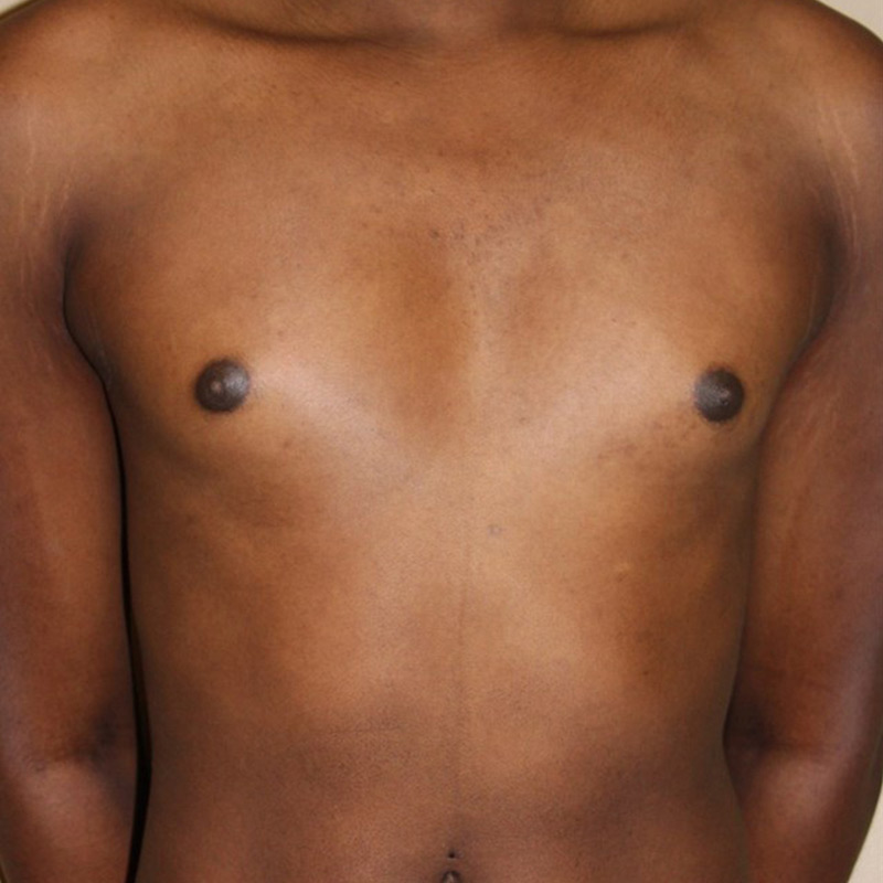 Mtf Breast Augmentation 01