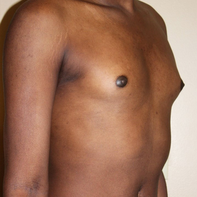 Mtf Breast Augmentation 03