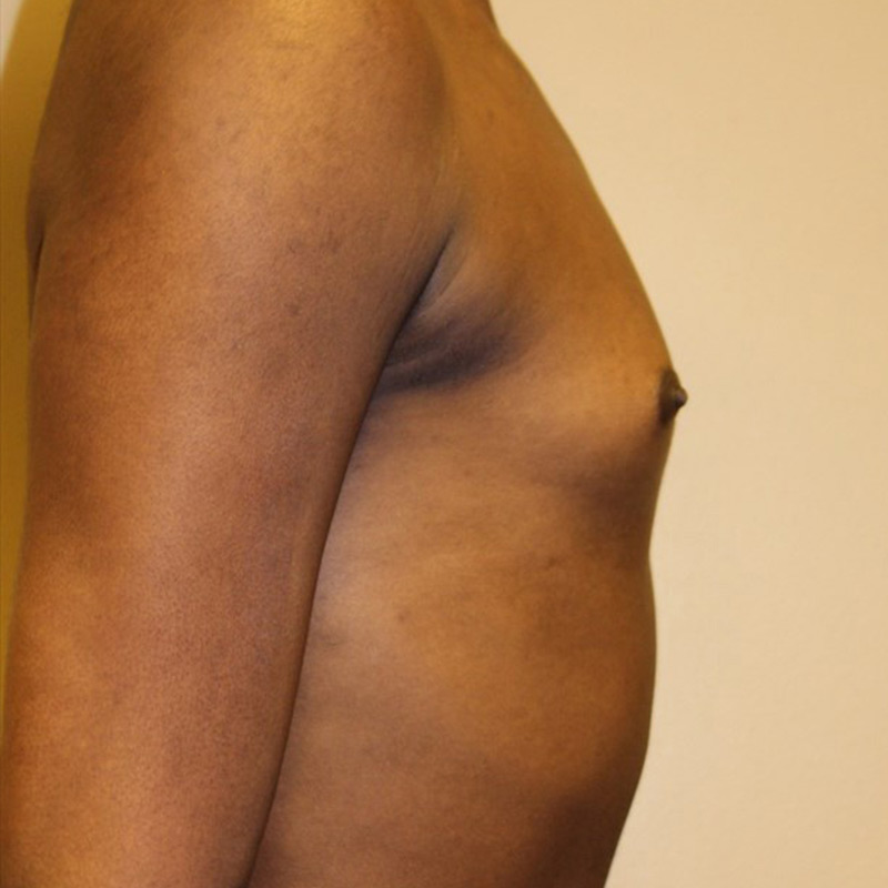 Mtf Breast Augmentation 05