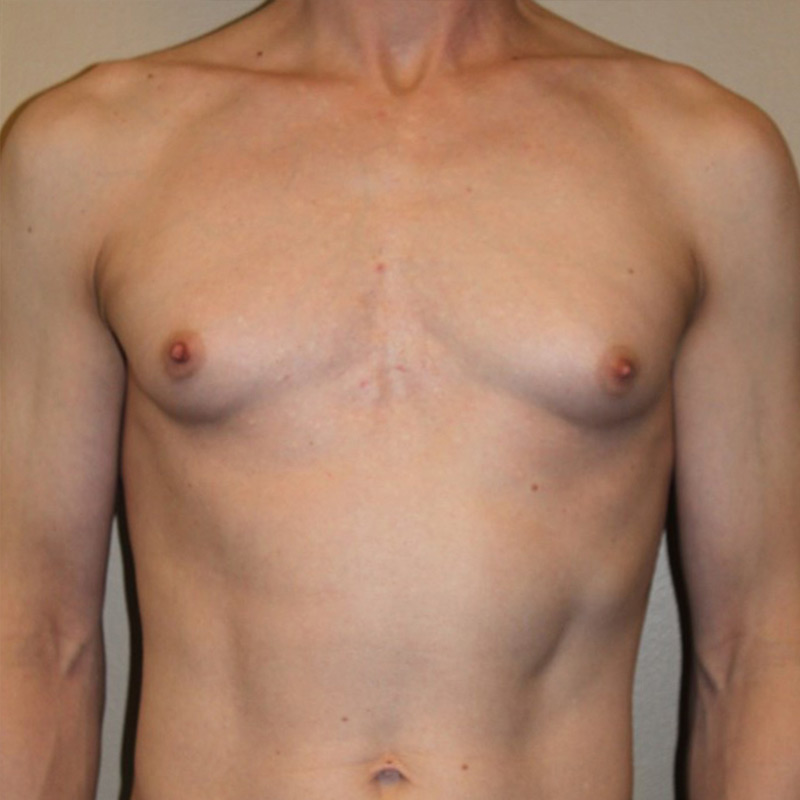 Mtf Breast Augmentation 01