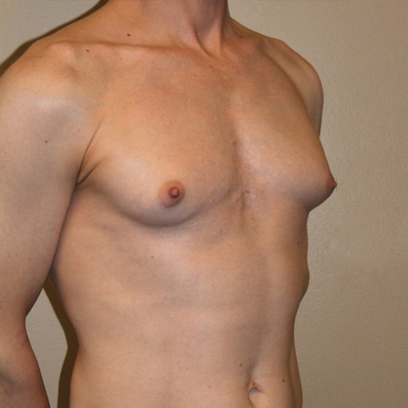 Mtf Breast Augmentation 03