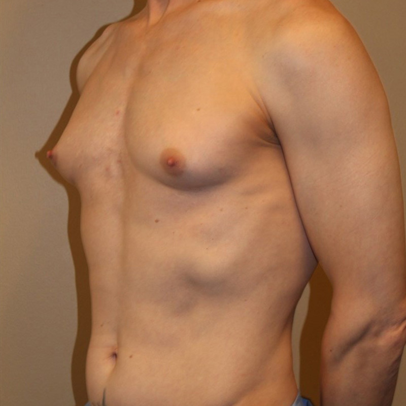 Mtf Breast Augmentation 07