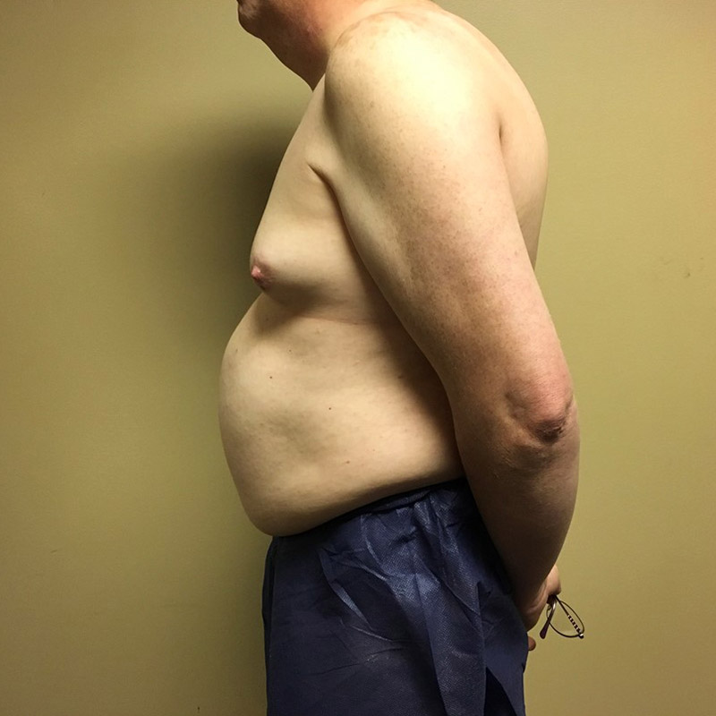 Mtf Breast Augmentation 03