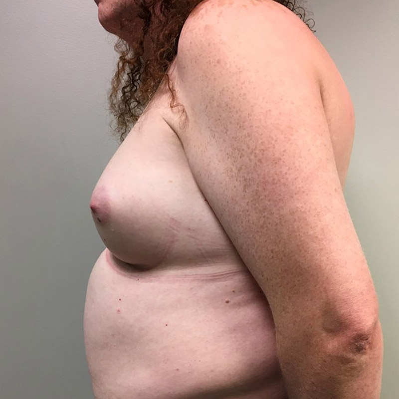 Mtf Breast Augmentation 03